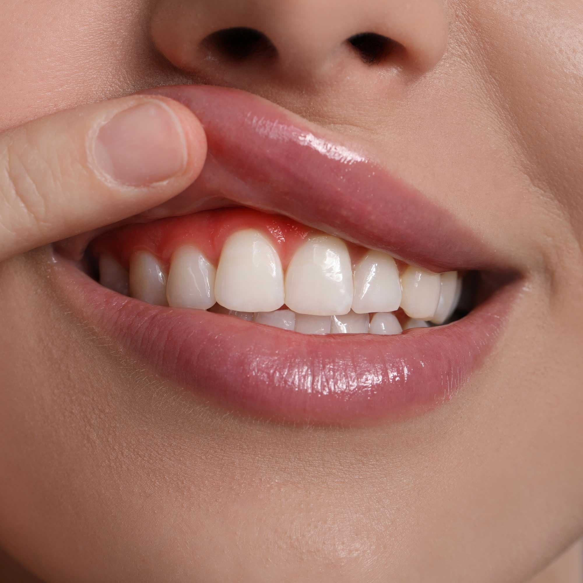 Enxerto de Gengiva e Tecidos Moles