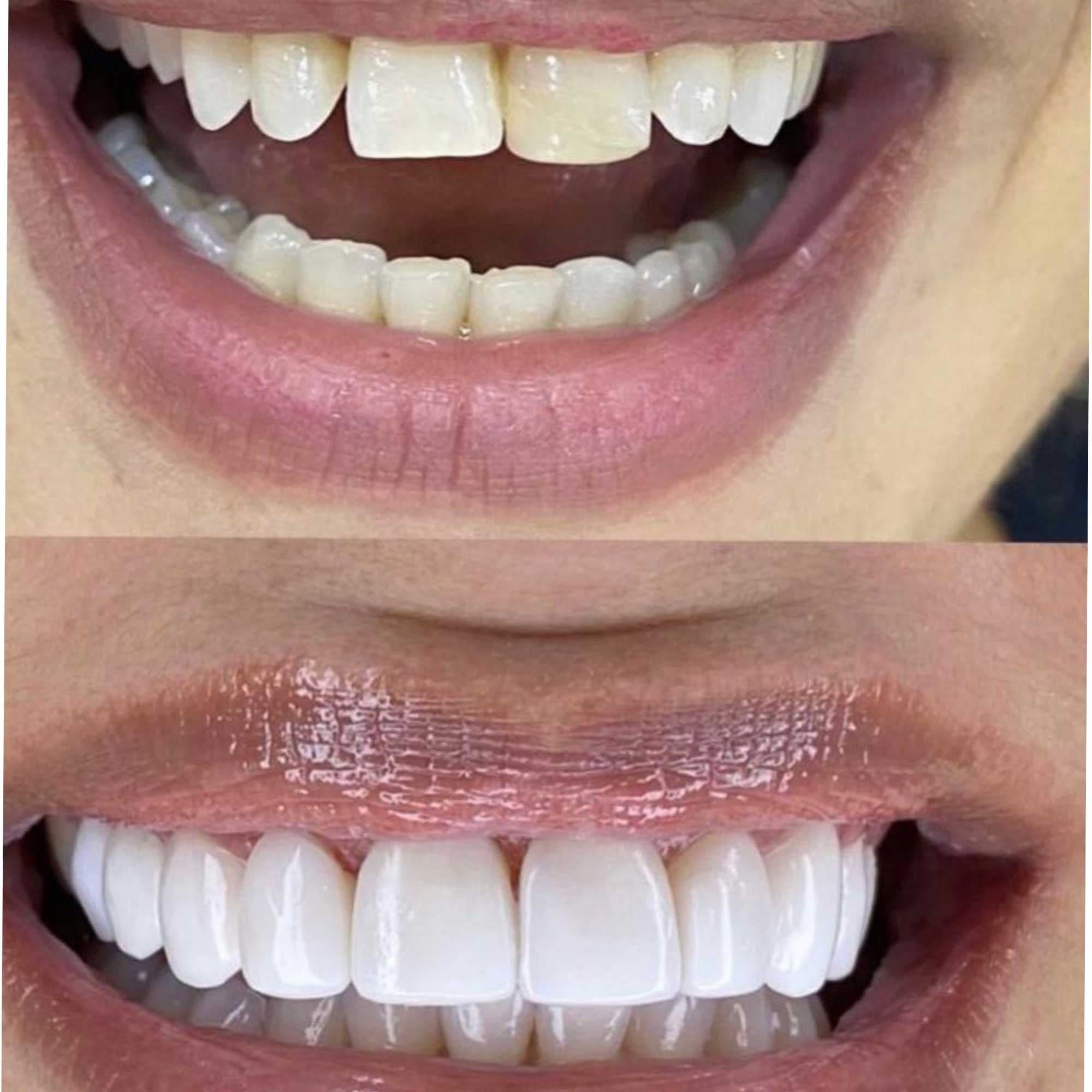 Lentes de Contato Dentais