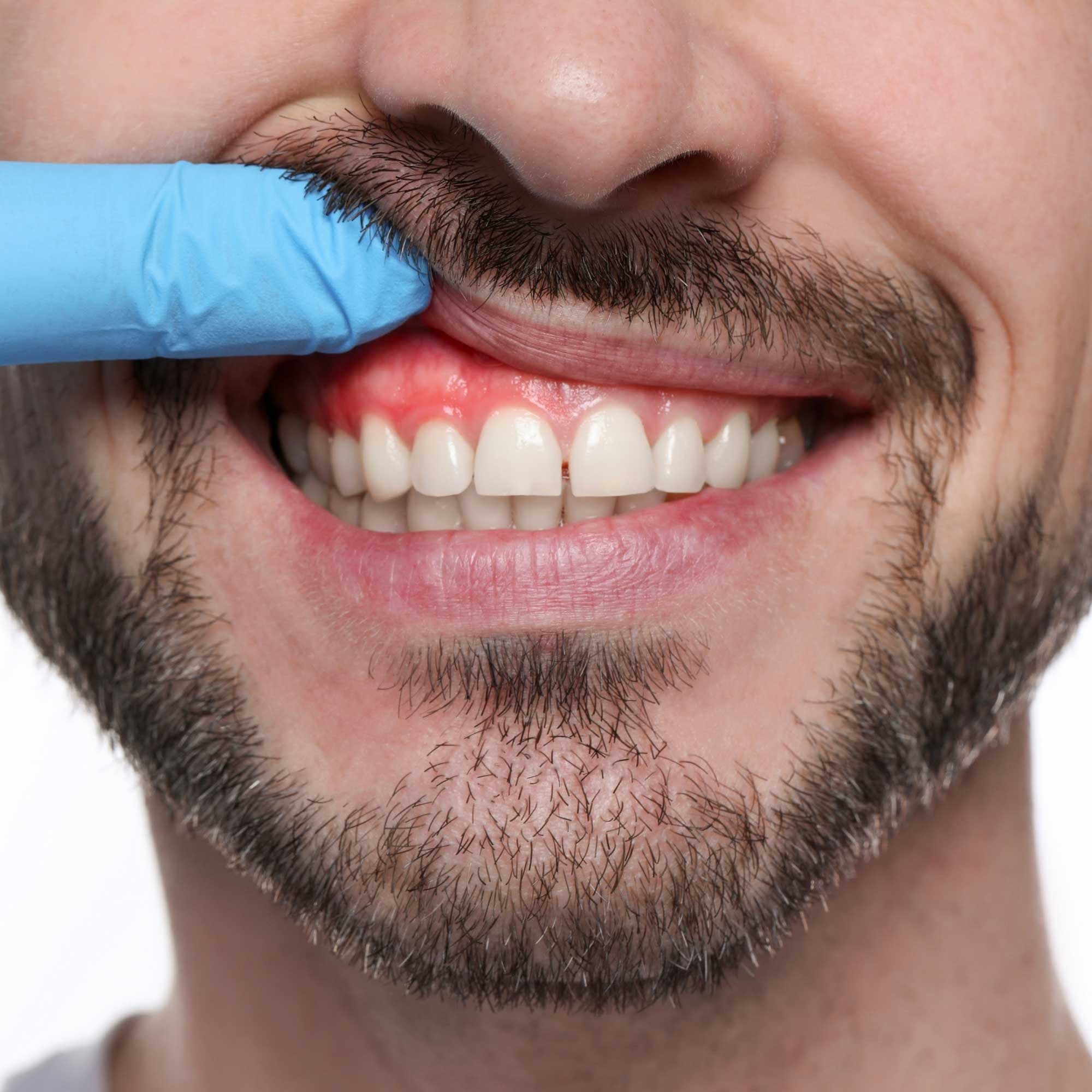 Periodontia Avançada – Tratamento da Gengiva e Tecidos Moles