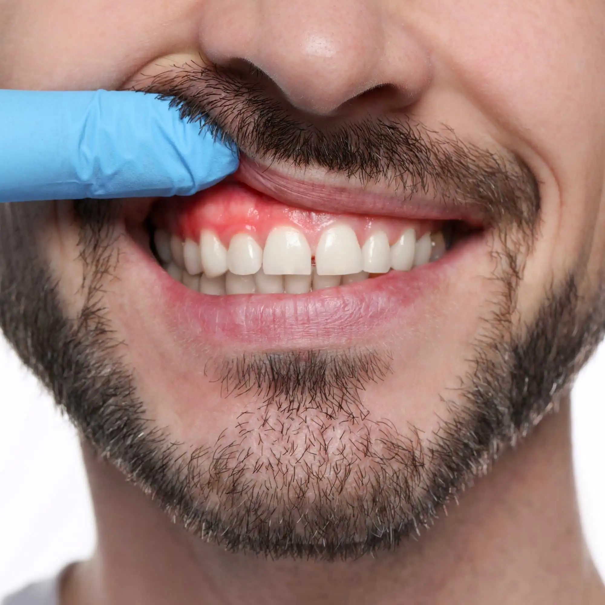 Periodontia Avançada – Tratamento da Gengiva e Tecidos Moles Periodontia Avançada – Tratamento da Gengiva e Tecidos Moles