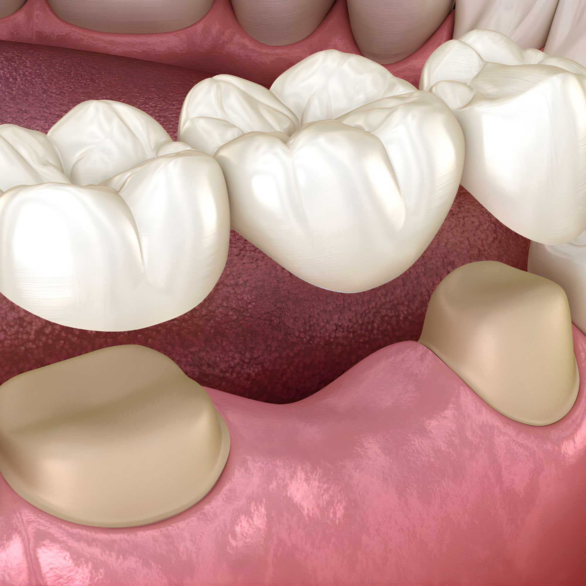 Prótese Dentária sobre Dentes Naturais