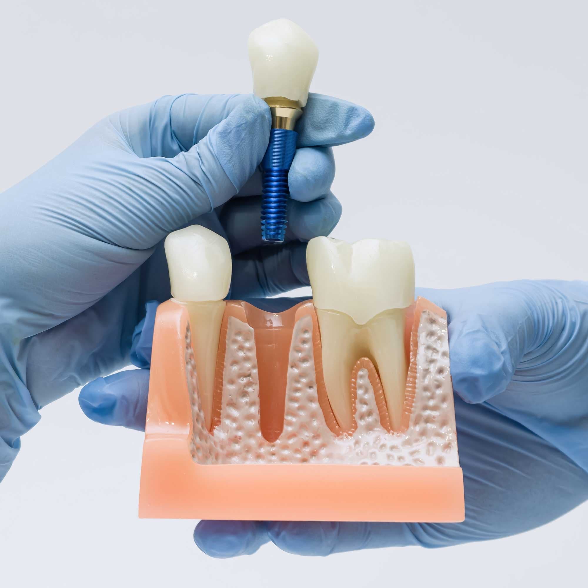 Prótese Dentária sobre Implantes