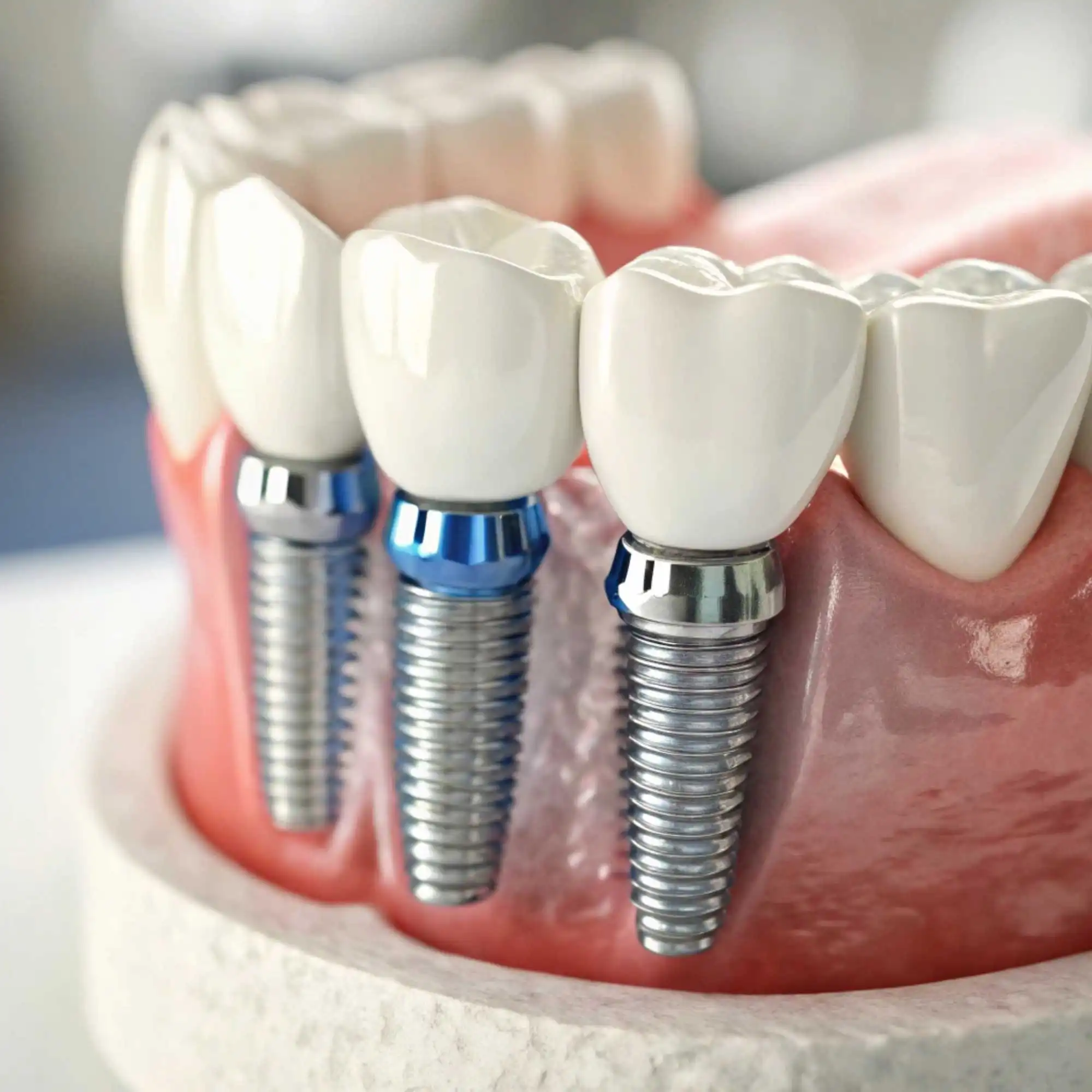 Reabilitação Oral Completa com Implantes Reabilitação Oral Completa com Implantes