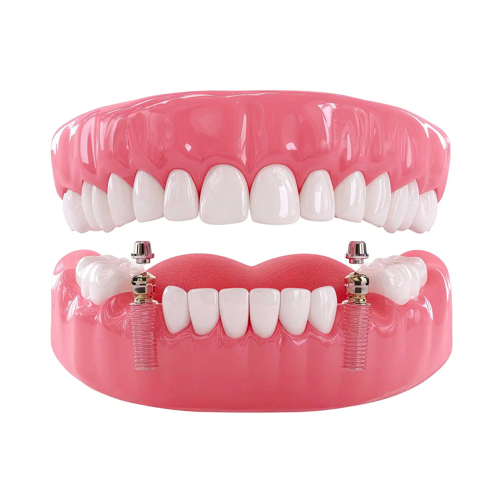 Reabilitação Oral Mista com Implantes e Próteses sobre Dentes Naturais Reabilitação Oral Mista com Implantes e Próteses sobre Dentes Naturais
